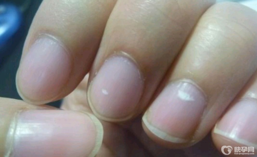 指甲盖上有白色块是什么原因？要如何改善?