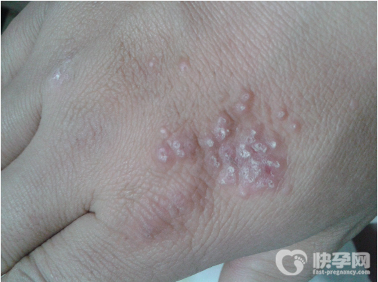 手上起小水泡是怎么回事？手上起水泡怎么护理？