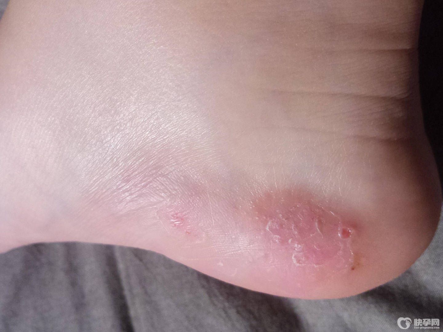 脚上起水泡是怎么回事？要怎么办？