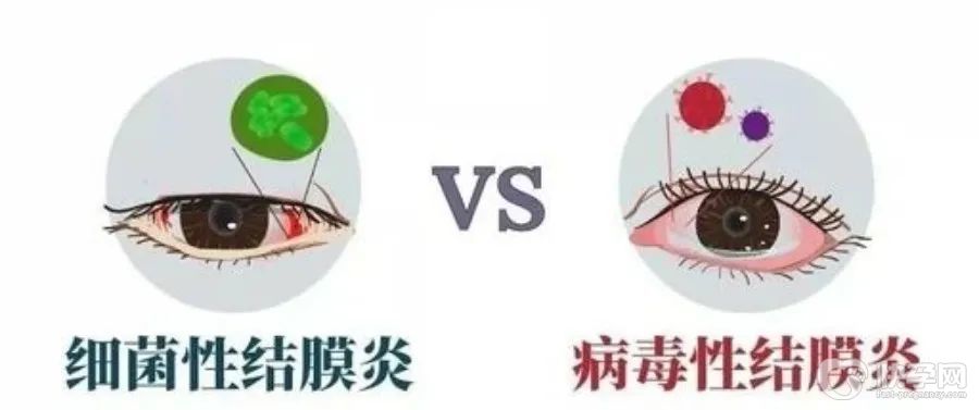 结膜炎会传染给别人吗?需要注意什么？