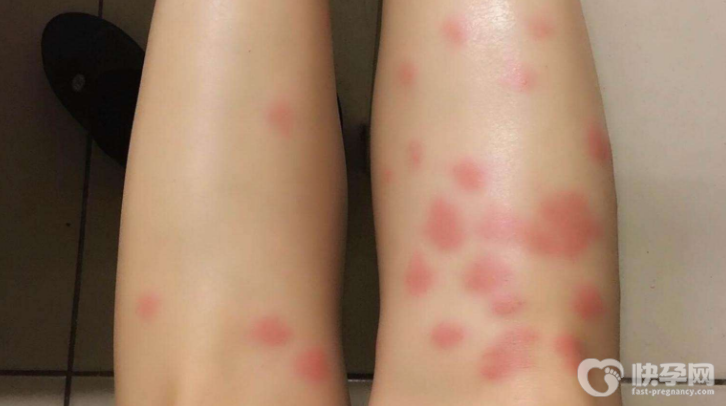 被跳蚤咬了用什么药最有效？跳蚤要如何有效预防？