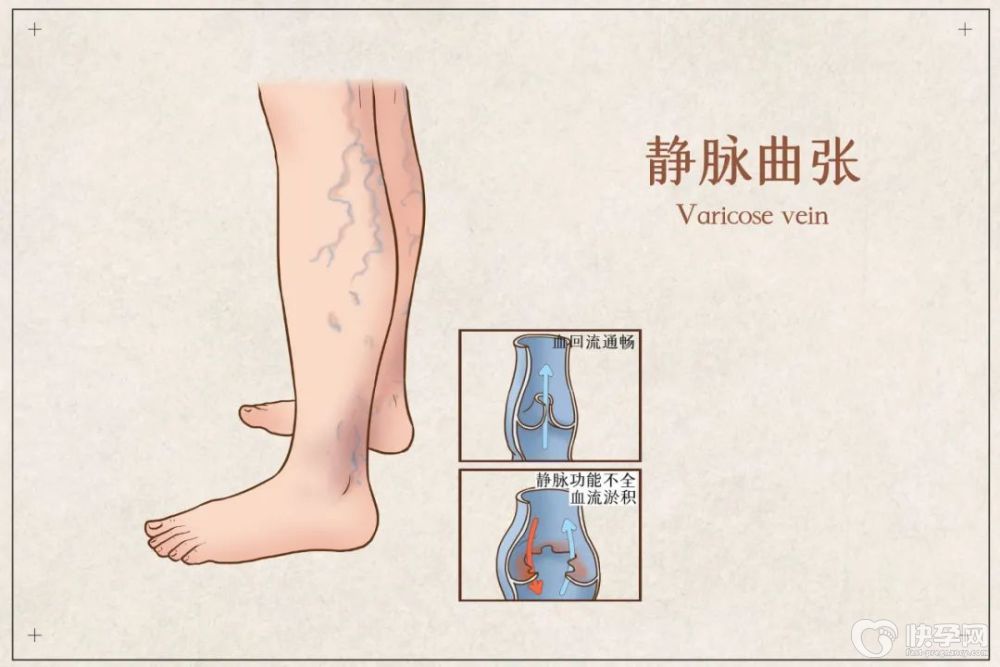下肢静脉曲张需要治疗吗？有哪些影响？