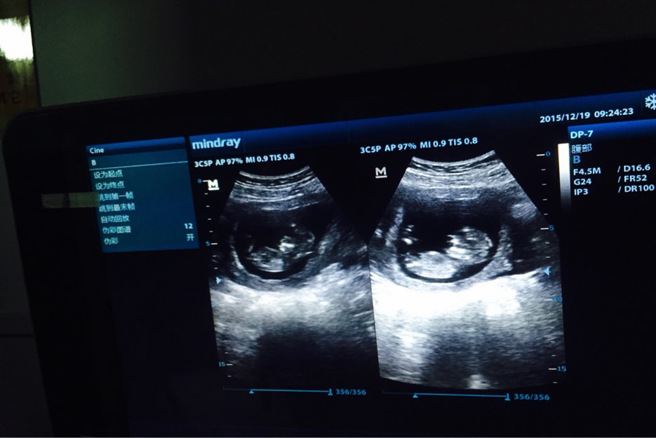 通过nt报告数值看男女你还在相信-这5招才是最科学的办法