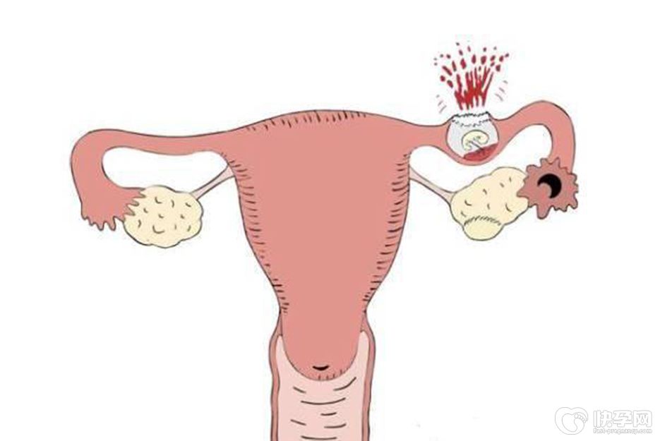 宫外孕是什么原因造成的-这6种情况是导致宫外孕的罪魁祸首