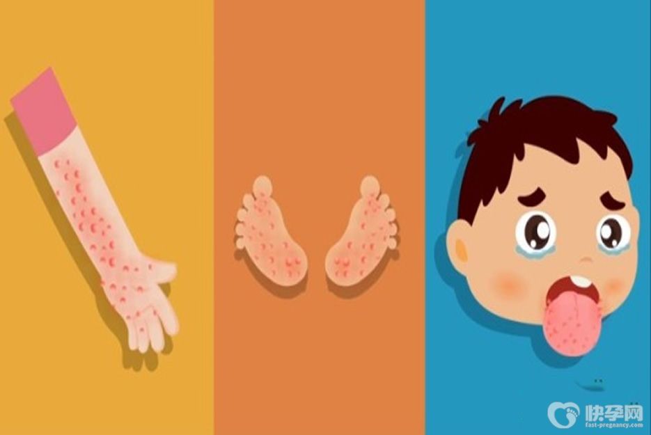 儿童手足口病一般几天能好？第几天的时候最严重已做详细解释