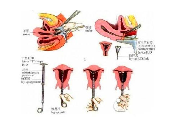 避孕环下移_避孕环下移的原因_避孕环下移怎么办