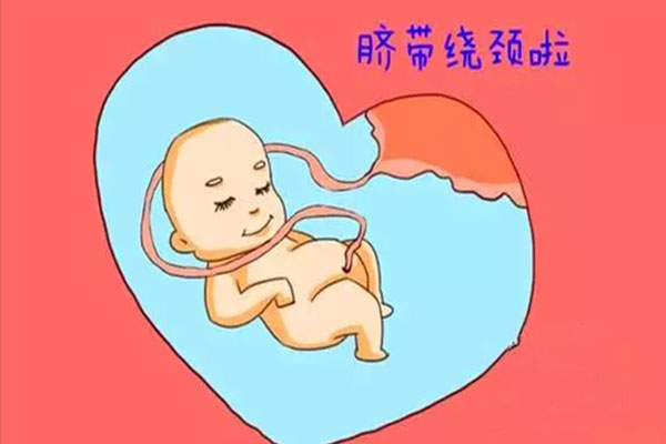第一胎脐带绕颈第二胎还会吗