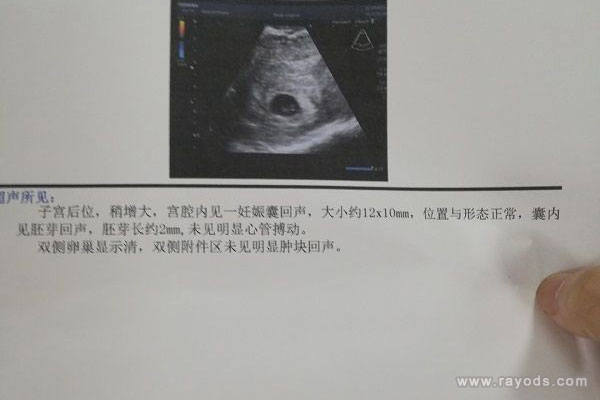 空孕囊的症状有哪些？空孕囊会有妊娠反应吗