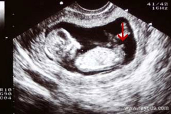 nub平行 生了男孩 不准 网友道出背后真相