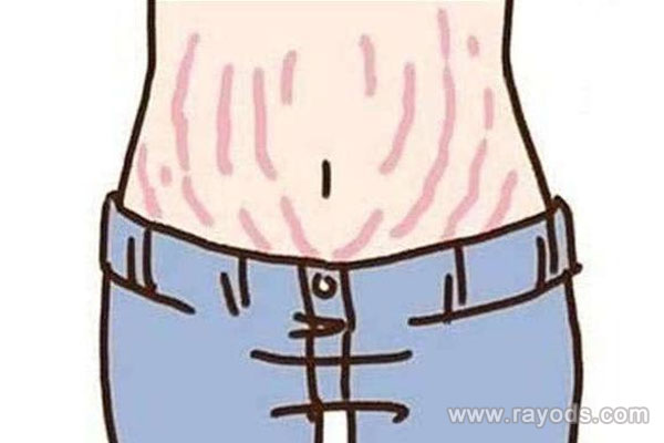 妊娠纹形成的原因介绍，妊娠纹可以预防？