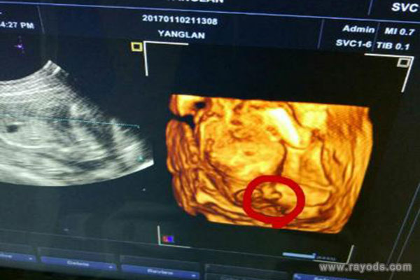 3个亮点是男孩 四维彩超单有3个红色的小点怎么回事