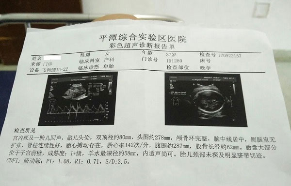 脐动脉s/d数据看男女方法分享，数值小于2是男孩真别不信