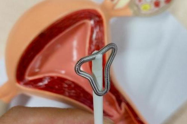 避孕环有几种_避孕环能用多久_避孕环的有效期