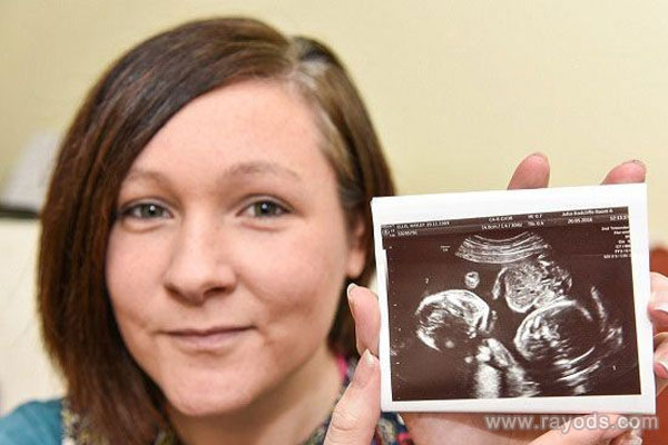 怀孕知识分享：B超首次揭示羊膜囊形成时间