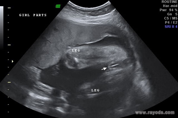 生下男宝,但b超三条线 合理孕周看男女是关键