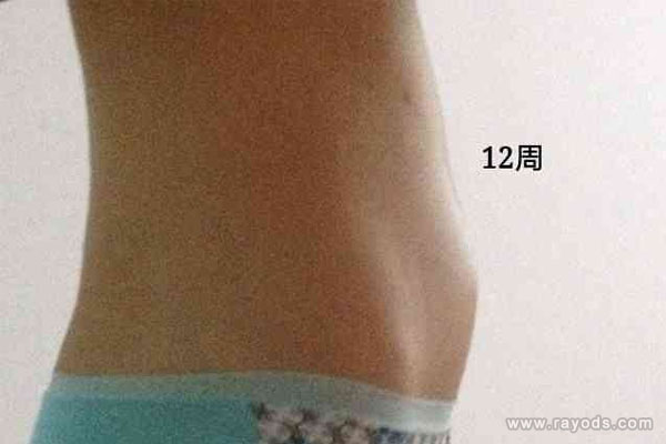 怀孕三个月肚子有多大，怀孕三个月胎儿图