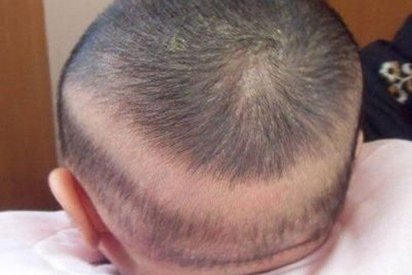 宝宝后面一圈不长头发 枕秃几个月开始几个月消失
