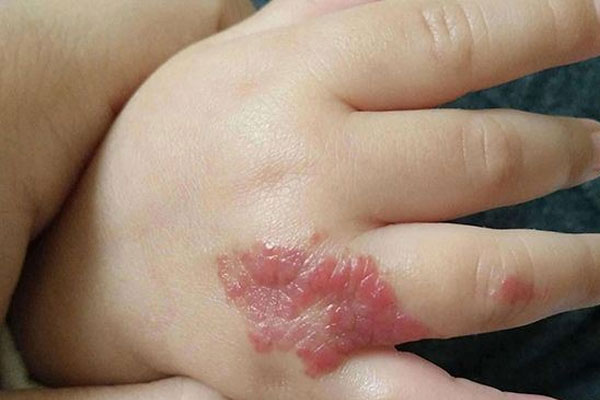 新生儿胎记有这十处位置最有福气分别在哪？