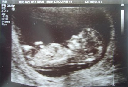 英国nub原理看男女准不准，nub平行一定是女宝吗？