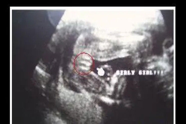 女宝b超三条线是哪三条,想要生女宝的孕妈一起来看看