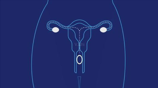 避孕环的副作用_避孕环好吗_上避孕环的注意事项