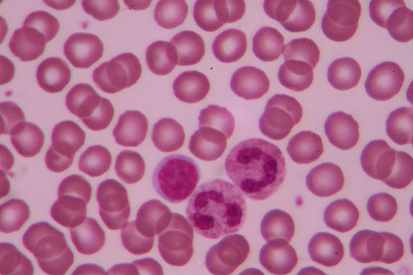 白细胞偏低的原因有哪些