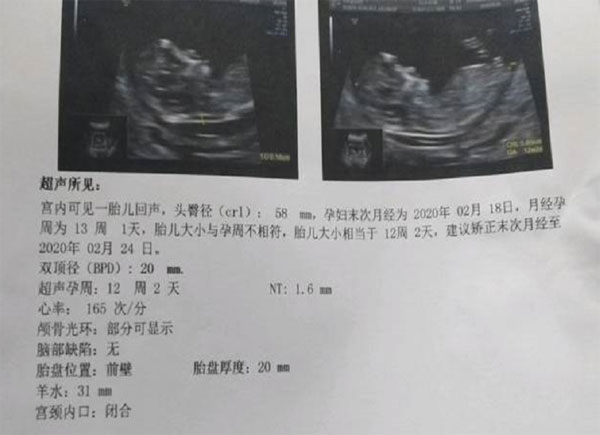 13周的NT结果显示1.6mm，一般是男孩女孩？