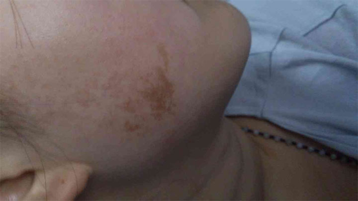 最有福气的10处胎记，头顶有胎记的女孩要恭喜了