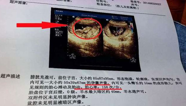 B超单子怎么看生男生女?这些方法的结果真的准确吗？