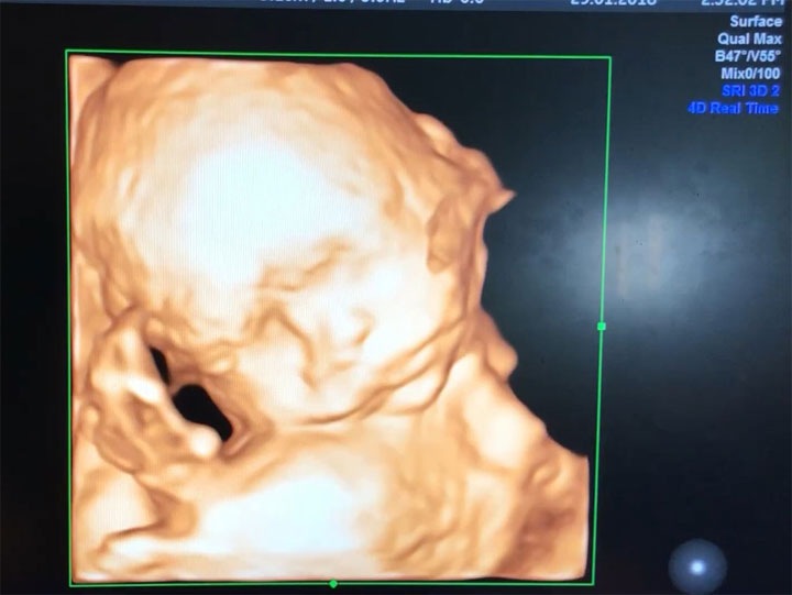 四维彩超看男女的方法,一分钟就可以判断出生男生女!