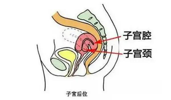 宫后倾影响怀孕吗?主要有以下几种情况