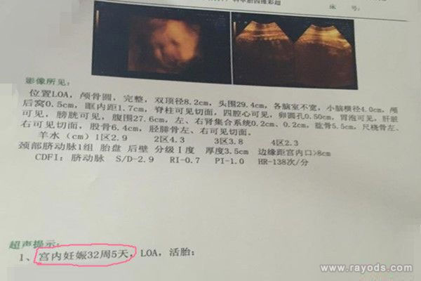 怀孕八个月胎儿图-怀孕八个月B超真实胎儿图