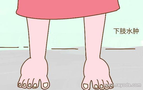 孕妇水肿是正常or生病？专家教你四招来辨别