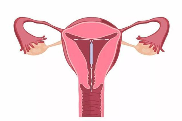 上环是什么意思？女人上环的利与弊