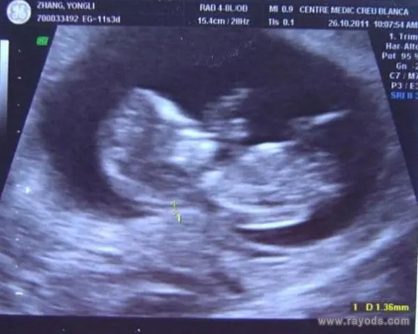 为啥男孩的nt值偏高 胎儿nt值偏高的三大原因