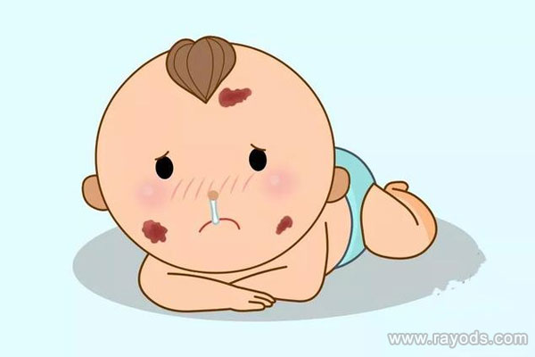 胎记是怎么形成的？孕妇怎么避免孩子长胎记