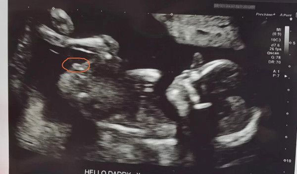 nt值可以辨认胎儿男女？有经验的孕妈告诉你背后的真相