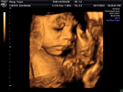 四维女宝宝三条线特征图片长什么样，四维男宝也有三条线吗？