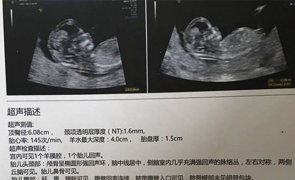 NT值越小胎宝宝就越聪明?并没有科学依据