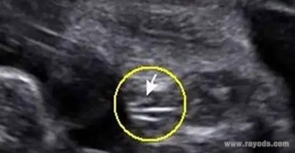 b超单有这个一般是女孩 有这个标志98%会生女孩