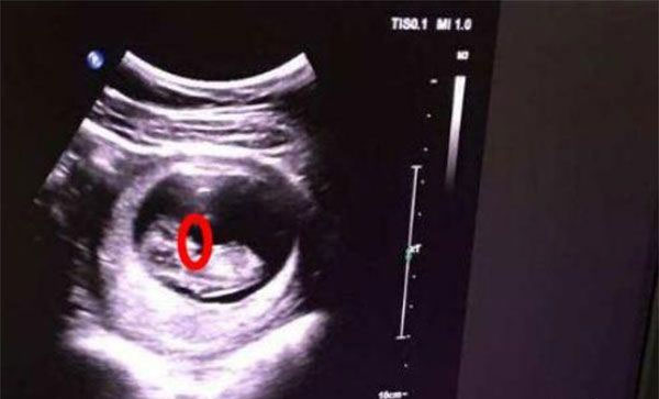 nt检查报告单图片是什么样子?NT报告数值看男女准确吗