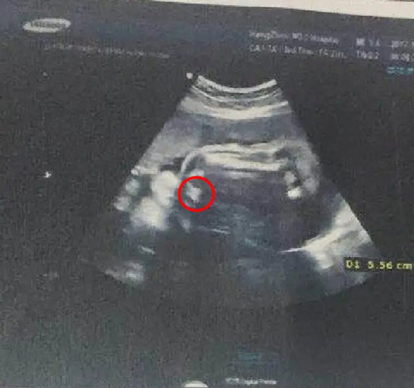 NT三个亮点是男孩女孩 男孩女孩生殖特征点区别