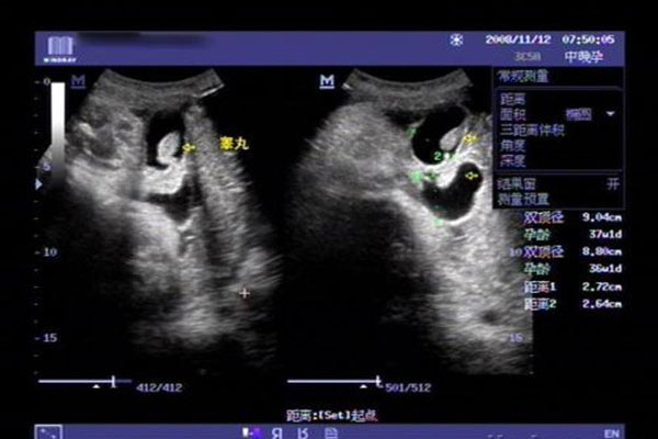 孕26周四维下睾丸的样子 如何看四维彩超识性别呢？