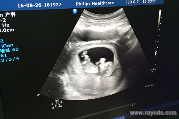 nt三个亮点医生说boy nt检查看男女其实并不准