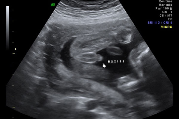 四维彩超男女腿部间的区别是什么样的？