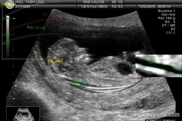 nt超声是从哪个部位检查?超声nt是检查什么？