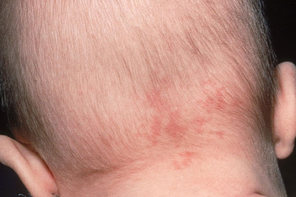 什么颜色的胎记对身体不好？哪种胎记会影响健康