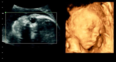 四维彩超男孩翻盘实例，为什么四维是男孩结果生女孩？