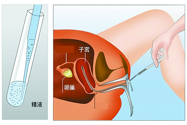 人工授精费用多少钱？一个周期大概需要六七千元