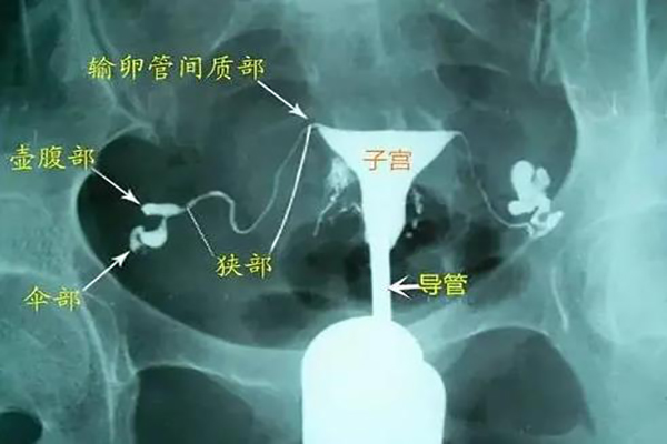 为什么输卵管造影不要随便做？医生说这些损伤不可逆！